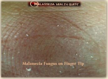 Malassezia yeasts, everywhere and sometimes dangerous ...