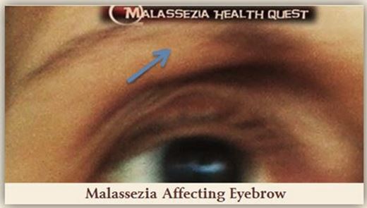 Malassezia affecting Eyebrows-MQ