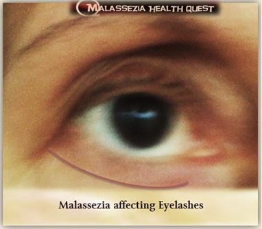 Malassezia affecting Eyelashes-MQ