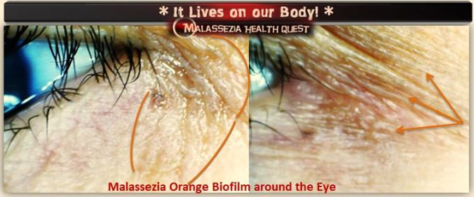 Malassezia Biofilm around Eye-MQ