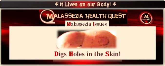 Malassezia Digging Holes-MQ