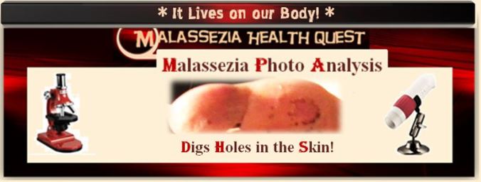 Malassezia Digs Holes -MQ