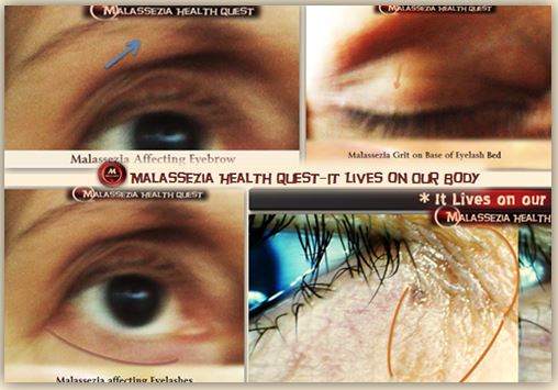 Malassezia Eye Symptoms