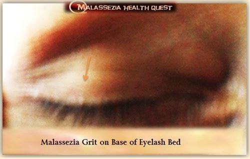 Malassezia Grit on Eyelash bed-MQ