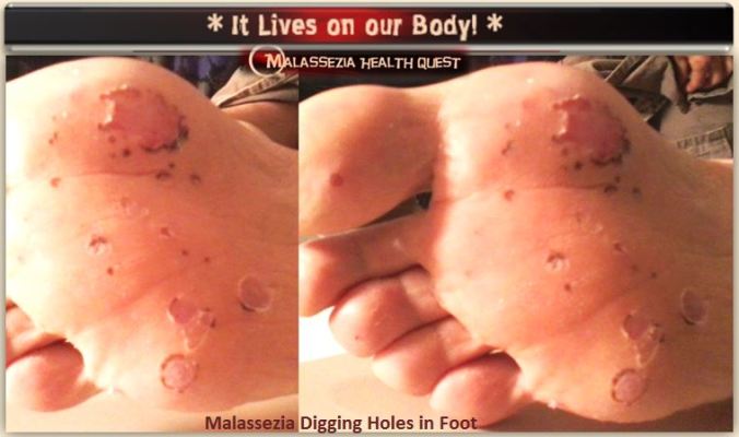 Malassezia on Foot 1-MQ
